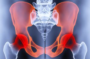 csípőízület kezelésének coxarthrosis deformáló artrózisa