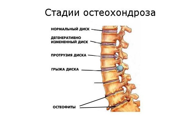 gerinctelen artrózis kezelése)