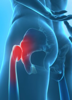 a csípőízület kétoldalú deformáló artrózisa