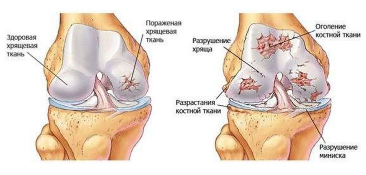artrózis kezelése kondroprotektorokkal fájó ízületek a láb kezelés