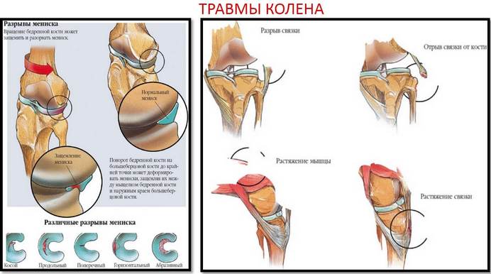 futópad a csípőízület artrózisához