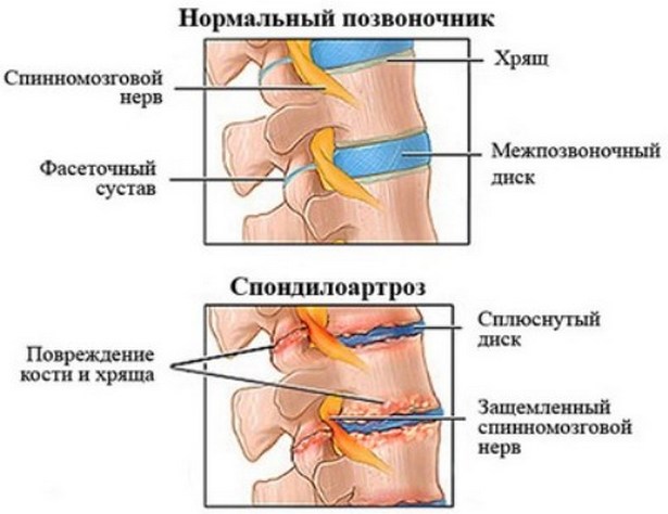 chondroprotektorok ára térd artrózisában)